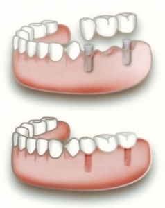 Implantologia dentale